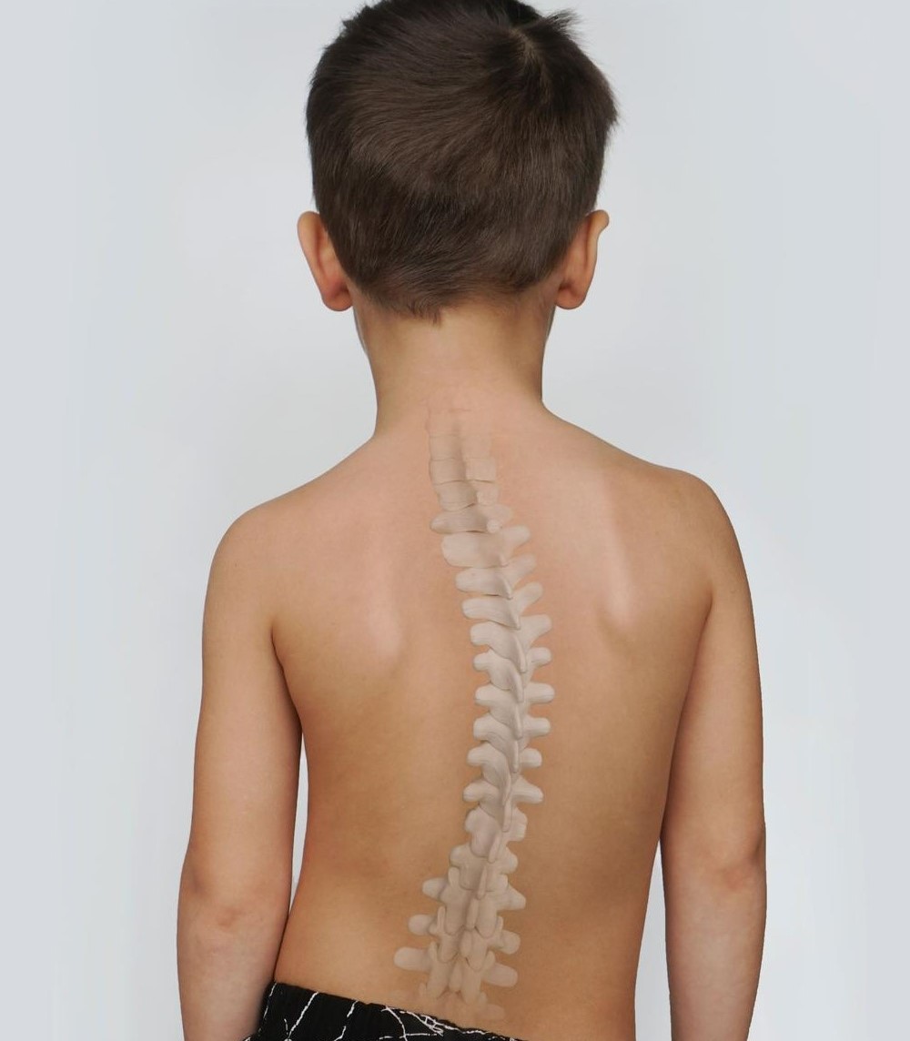Living Well with Scoliosis